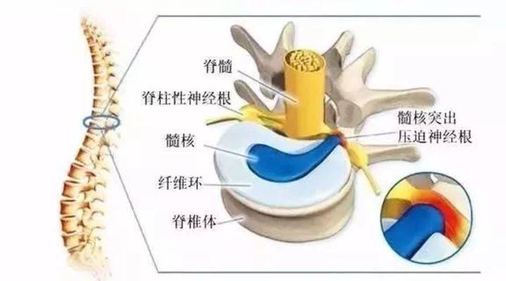 11月2日根線蟲最新根治法詳解，有效治療根線蟲的方法與解析