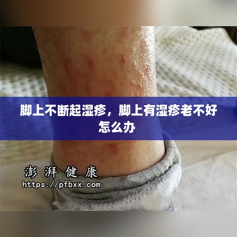 腳上不斷起濕疹，腳上有濕疹老不好怎么辦 