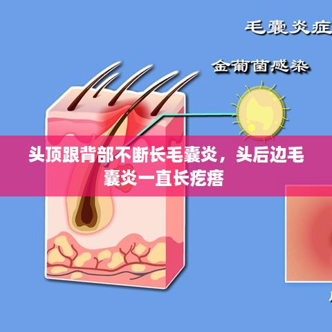 頭頂跟背部不斷長毛囊炎，頭后邊毛囊炎一直長疙瘩 